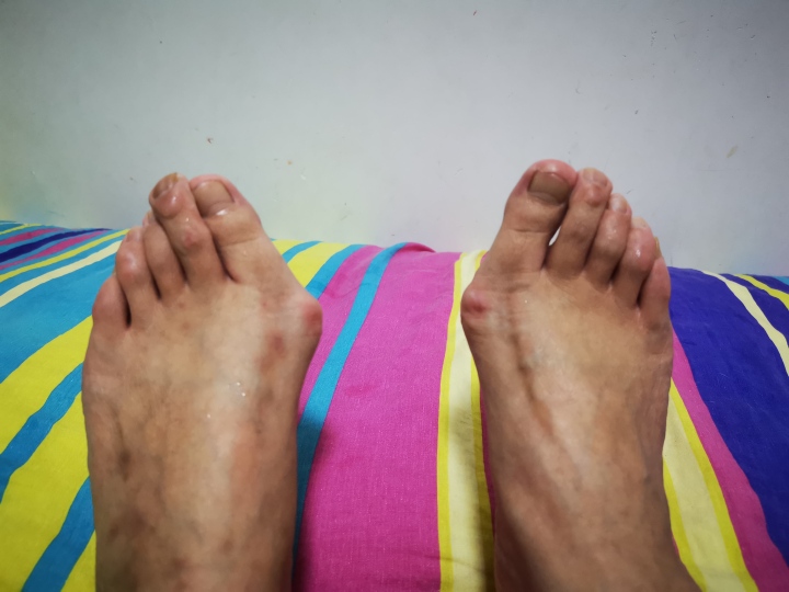 女性拇外翻脚有哪些症状和影响