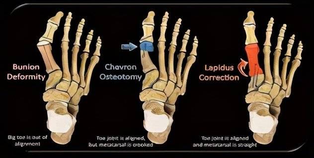 拇外翻的手术怎么做？大脚骨手术的做法