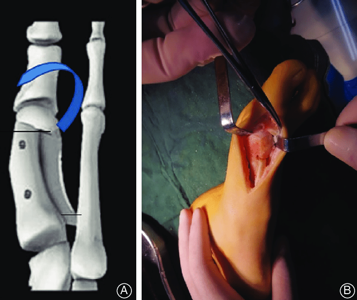 拇外翻手术截骨是否需要做到严丝合缝，拇外翻手术