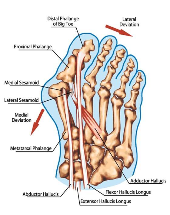 拇外翻为何不宜穿人字拖，肌腱对拇外翻的影响