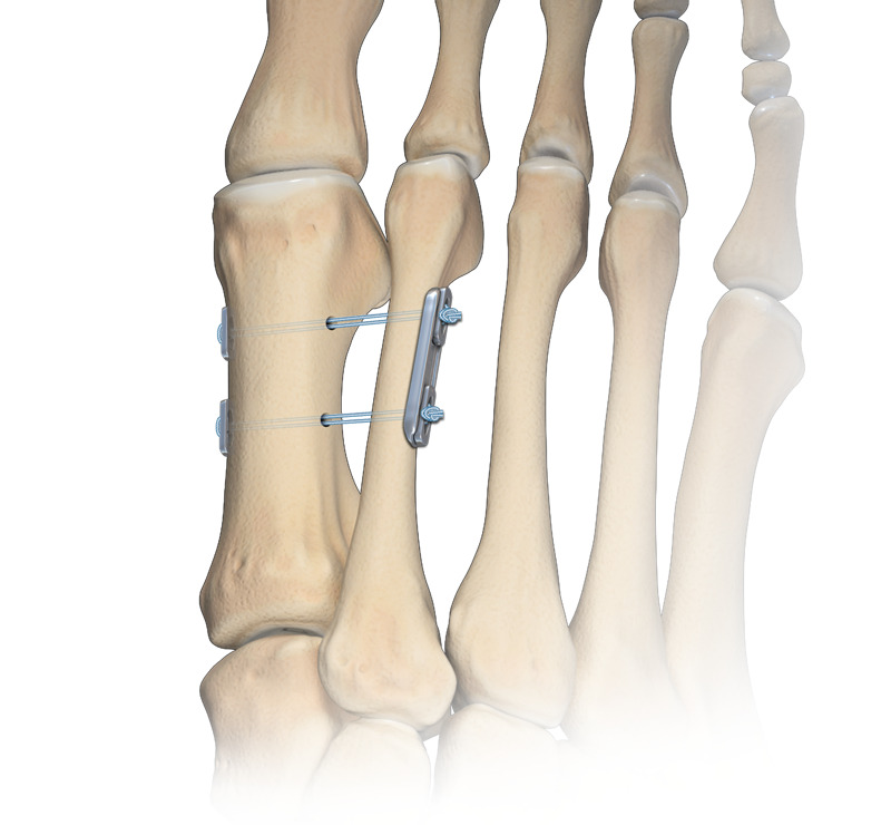 不截骨矫正拇外翻，第二跖骨牵拉第一跖骨矫正拇外翻