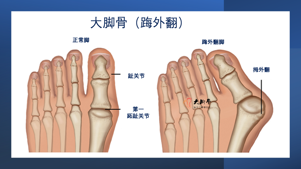 做大脚骨手术后脚会不会变窄，拇外翻手术